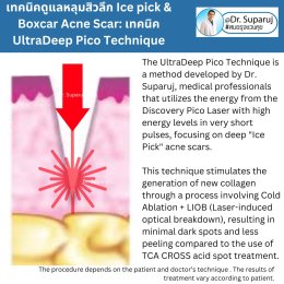  แนะนำเทคนิครักษาหลุมสิวจิกลึก Ice Pick Acne Scar ด้วยเทคนิคเลเซอร์ UltraDeep Pico Technique (Ice Pick Acne Scar Treatment with Discovery Pico Laser + UltraDeep Pico Technique)