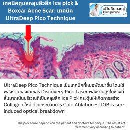  แนะนำเทคนิครักษาหลุมสิวจิกลึก Ice Pick Acne Scar ด้วยเทคนิคเลเซอร์ UltraDeep Pico Technique (Ice Pick Acne Scar Treatment with Discovery Pico Laser + UltraDeep Pico Technique)