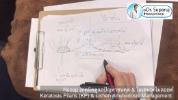  Recap เทคนิคดูแลปัญหาขนคุด & ไลเคนอะไมลอยด์ Keratosis Pilaris (KP) & Lichen Amyloidosis Management