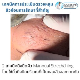 เทคนิคการประเมินตรวจหลุมสิวก่อนการรักษา Acne Scar Evaluation & Assessment