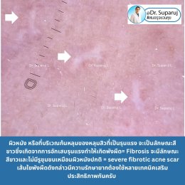 แผลเป็นจากสิวที่มีลักษณะสีขาว severe fibrotic acne scar เกิดจากอะไร & ดูแลได้อย่างไร ?