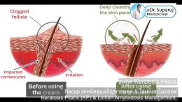  Recap เทคนิคดูแลปัญหาขนคุด & ไลเคนอะไมลอยด์ Keratosis Pilaris (KP) & Lichen Amyloidosis Management