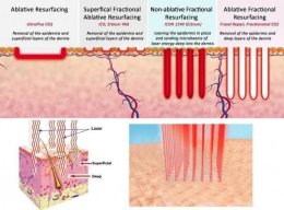 โปรแกรมเลเซอร์ Fractional CO2 Laser ยังใช้รักษาหลุมสิวได้อยู่ไหม ?