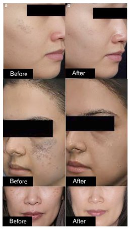 เทคนิครักษากระโฮริ กระลึก ปานโฮริ (Hori's nevus) ด้วยเลเซอร์ Discovery Picosecond Laser