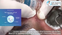 แนะนำเทคนิคในการดูแลหลุมสิว: Exosome ใน การรักษาหลุมสิว (Exosome & acne scar treatment)