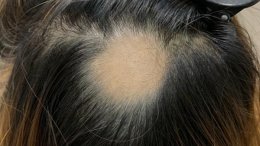 ภาวะผมร่วงเป็นหย่อม Alopecia Areata AA หลังฉีดวัคซีนโควิด-19 เกิดจากอะไรดูแลได้ อย่างไร?