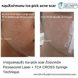  แนะนำเทคนิครักษาหลุมสิวจิกลึก Ice Pick Acne Scar ด้วยเทคนิคเลเซอร์ UltraDeep Pico Technique (Ice Pick Acne Scar Treatment with Discovery Pico Laser + UltraDeep Pico Technique)