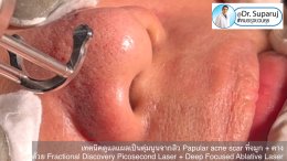 เทคนิคดูแลแผลเป็นตุ่มนูนจากสิว Papular acne scar ที่จมูก + คาง ด้วย Fractional Discovery Picosecond Laser + Deep Focused Ablative Laser