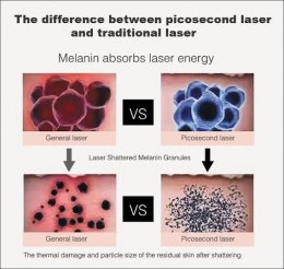 เทคนิคเลเซอร์ลบรอยสักคิ้วด้วย Discovery Picosecond Laser (Discovery Picosecond Laser for Eyebrow Tattoo Removal)