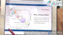 Update Discovery Picosecond Laser จุดเด่น & หลักการทำงาน ใช้ดูแลหลุมสิว แผลเป็น รอยแตกลาย ฝ้า กระจุดด่างดำ ได้อย่างไร ? 