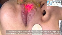 แนะนำเทคนิคดูแลริมฝีปากคล้ำ Lip Hyperpigmentation ริ้วรอย ริ้วรอยรอบริมฝีปาก: สาเหตุ การดูแล & เทคนิคเลเซอร์ MultiMode Discovery Picosecond Laser Lip Rejuvenation