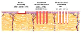 โปรแกรมเลเซอร์ Fractional CO2 Laser ยังใช้รักษาหลุมสิวได้อยู่ไหม ?