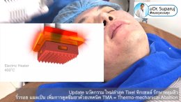 Update นวัตกรรมใหม่ล่าสุด Tixel ทิ๊กเซลล์ รักษาหลุมสิว ริ้วรอย แผลเป็น + Periorbital Tixel Treatment ดูแลริ้วรอยเปลือกตาและรอบดวงตาด้วยเทคนิค TMA = Thermo-mechanical Abaltion