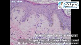  Recap เทคนิคดูแลปัญหาขนคุด & ไลเคนอะไมลอยด์ Keratosis Pilaris (KP) & Lichen Amyloidosis Management