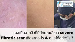 แผลเป็นจากสิวที่มีลักษณะสีขาว severe fibrotic acne scar เกิดจากอะไร & ดูแลได้อย่างไร ?