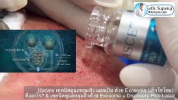 แนะนำเทคนิคในการดูแลหลุมสิว: Exosome ใน การรักษาหลุมสิว (Exosome & acne scar treatment)