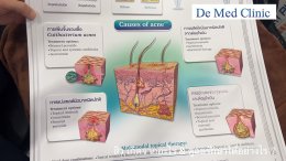 สิว เกิดจากอะไร & ดูแลรักษาได้อย่างไร ?