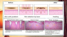 เทคนิคดูแลปัญหาหลุมสิว แผลเป็น รูขุมขนกว้าง ด้วย Fractional non ablative 1470 nm Laser: Program LaserME