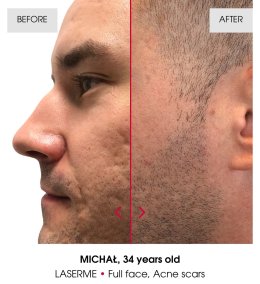 เทคนิคดูแลปัญหาหลุมสิว แผลเป็น รูขุมขนกว้าง ด้วย Fractional non ablative 1470 nm Laser: Program LaserME