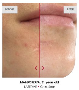 เทคนิคดูแลปัญหาหลุมสิว แผลเป็น รูขุมขนกว้าง ด้วย Fractional non ablative 1470 nm Laser: Program LaserME