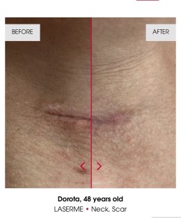 เทคนิคดูแลปัญหาหลุมสิว แผลเป็น รูขุมขนกว้าง ด้วย Fractional non ablative 1470 nm Laser: Program LaserME