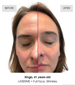 เทคนิคดูแลปัญหาหลุมสิว ด้วย Fractional non ablative 1470 nm Laser: Program LaserME