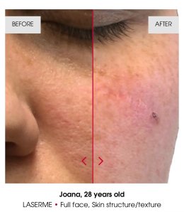 เทคนิคดูแลปัญหาหลุมสิว ด้วย Fractional non ablative 1470 nm Laser: Program LaserME