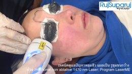 เทคนิคดูแลปัญหาหลุมสิว แผลเป็น รูขุมขนกว้าง ด้วย Fractional non ablative 1470 nm Laser: Program LaserME