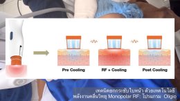 โปรแกรม Oligio แนะนำเทคโนโลยีการยกกระชับใบหน้าด้วย Monopolar RF (Radio Frequency) โดยใช้โปรแกรม Oligio โดยมีประเด็นสำคัญสรุปได้ดังนี้ครับ: