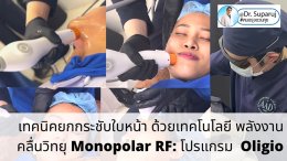 โปรแกรม Oligio แนะนำเทคโนโลยีการยกกระชับใบหน้าด้วย Monopolar RF (Radio Frequency) โดยใช้โปรแกรม Oligio โดยมีประเด็นสำคัญสรุปได้ดังนี้ครับ: