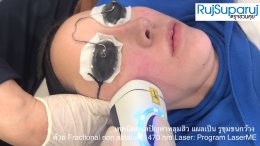 เทคนิคดูแลปัญหาหลุมสิว แผลเป็น รูขุมขนกว้าง ด้วย Fractional non ablative 1470 nm Laser: Program LaserME