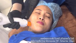 โปรแกรม Oligio แนะนำเทคโนโลยีการยกกระชับใบหน้าด้วย Monopolar RF (Radio Frequency) โดยใช้โปรแกรม Oligio โดยมีประเด็นสำคัญสรุปได้ดังนี้ครับ: