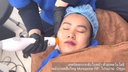 โปรแกรม Oligio แนะนำเทคโนโลยีการยกกระชับใบหน้าด้วย Monopolar RF (Radio Frequency) โดยใช้โปรแกรม Oligio โดยมีประเด็นสำคัญสรุปได้ดังนี้ครับ: