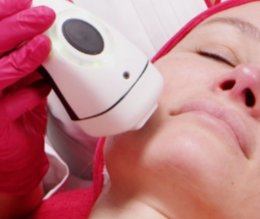 เทคนิคดูแลปัญหาหลุมสิว ด้วย Fractional non ablative 1470 nm Laser: Program LaserME