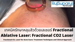อัปเดตเทคนิคการรักษาหลุมสิวด้วย Fractional Ablative Laser (Fractional CO2 Laser)