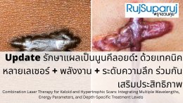 Update รักษาแผลเป็นนูนคีลอยด์: ด้วยเทคนิคหลายเลเซอร์ + พลังงาน + ระดับความลึก ร่วมกันเสริมประสิทธิภาพ Combination Laser Therapy for Keloid and Hypertrophic Scars: Integrating Multiple Wavelengths, Energy Parameters, and Depth-Specific Treatment Level