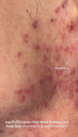 หลุมสิวที่มีรอยแดง Post Acne Redness and Acne Scar เกิดจากอะไร & ดูแลได้อย่างไร ?
