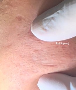 หลุมสิวลึกที่มีพังผืดสีขาว (Fibrosis/ Fibrotic white scar) สาเหตุและการดูแลรักษา