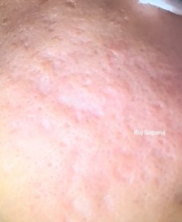 หลุมสิวลึกที่มีพังผืดสีขาว (Fibrosis/ Fibrotic white scar) สาเหตุและการดูแลรักษา