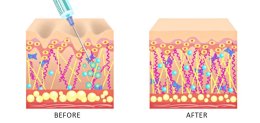 เทคนิครักษาหลุมสิว ด้วยการตัดพังผืดหลุมสิวเทคนิค Program Profhilo Bio-Remodeling Fanning Subcision Techniques for Acne Scar Treatment