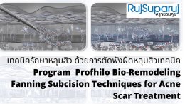 เทคนิครักษาหลุมสิว ด้วยการตัดพังผืดหลุมสิวเทคนิค Program Profhilo Bio-Remodeling Fanning Subcision Techniques for Acne Scar Treatment