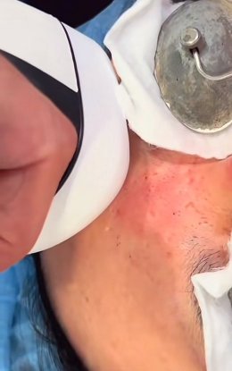 หลุมสิวที่มีรอยแดง Post Acne Redness and Acne Scar เกิดจากอะไร & ดูแลได้อย่างไร ?