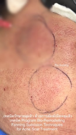 เทคนิครักษาหลุมสิว ด้วยการตัดพังผืดหลุมสิวเทคนิค Program Profhilo Bio-Remodeling Fanning Subcision Techniques for Acne Scar Treatment