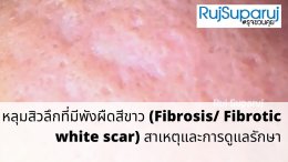 หลุมสิวลึกที่มีพังผืดสีขาว (Fibrosis/ Fibrotic white scar) สาเหตุและการดูแลรักษา