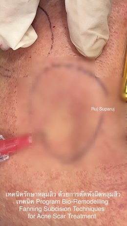 เทคนิครักษาหลุมสิว ด้วยการตัดพังผืดหลุมสิวเทคนิค Program Profhilo Bio-Remodeling Fanning Subcision Techniques for Acne Scar Treatment