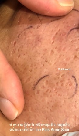 ทำความรู้จักชนิดหลุมสิว: Rolling, Boxcar และ Ice Pick Acne Scar