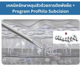 เทคนิครักษาหลุมสิว ด้วยการตัดพังผืดหลุมสิวเทคนิค Program Profhilo Bio-Remodeling Fanning Subcision Techniques for Acne Scar Treatment