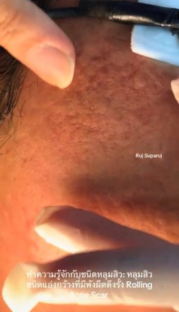ทำความรู้จักชนิดหลุมสิว: Rolling, Boxcar และ Ice Pick Acne Scar