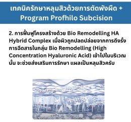 เทคนิครักษาหลุมสิว ด้วยการตัดพังผืดหลุมสิวเทคนิค Program Profhilo Bio-Remodeling Fanning Subcision Techniques for Acne Scar Treatment