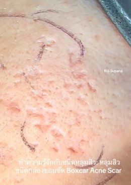 ทำความรู้จักชนิดหลุมสิว: Rolling, Boxcar และ Ice Pick Acne Scar